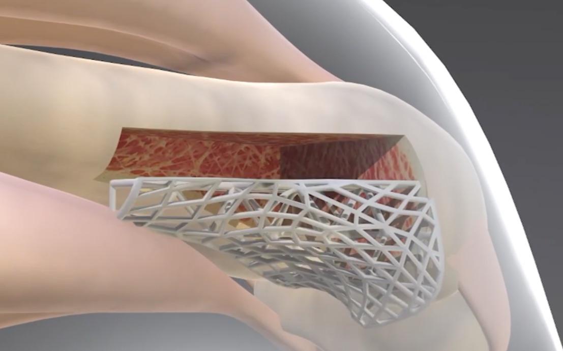 3D printing helping doctors repair their patients（3D printing benefits people）